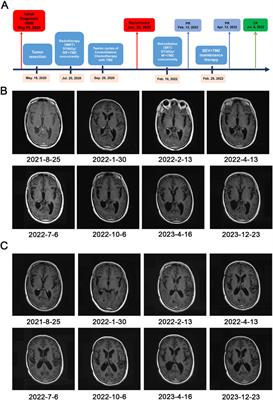 The efficacy of stereotactic radiotherapy followed by bevacizumab and temozolomide in the treatment of recurrent glioblastoma: a case report